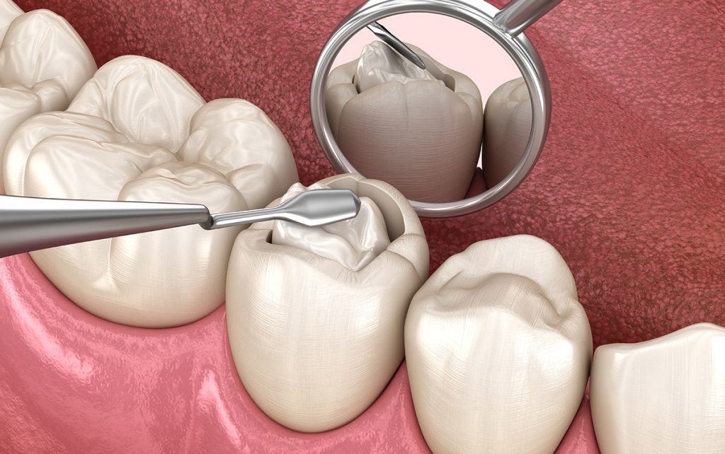 Aesthetic Fillings What You Need To Know Alfa